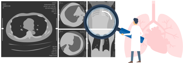 胸部CT肺ドックについて