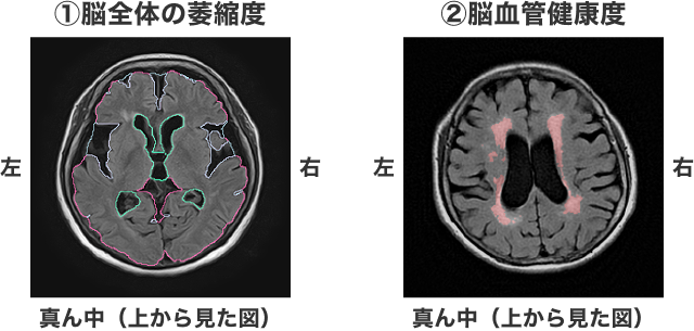MVision(脳萎縮チェック)について