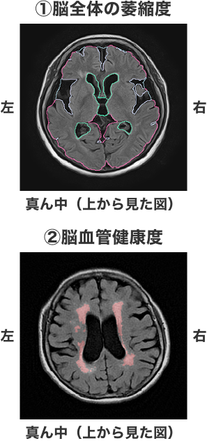 MVision(脳萎縮チェック)について